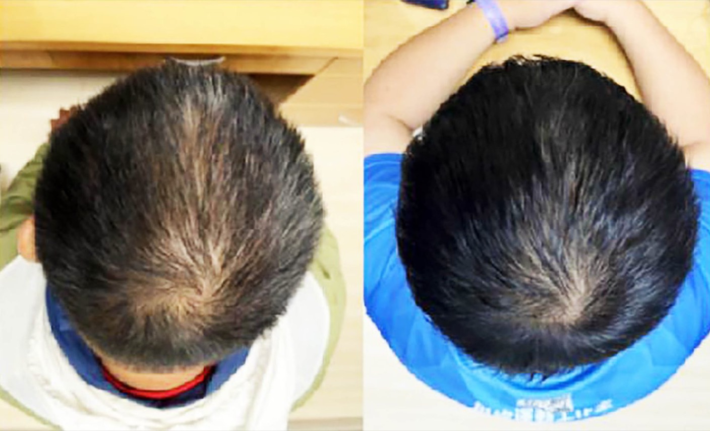 Centella Asiatica Plant Exosome Topical Serum Lifts Hair Density Nearly 25% in Eight Weeks