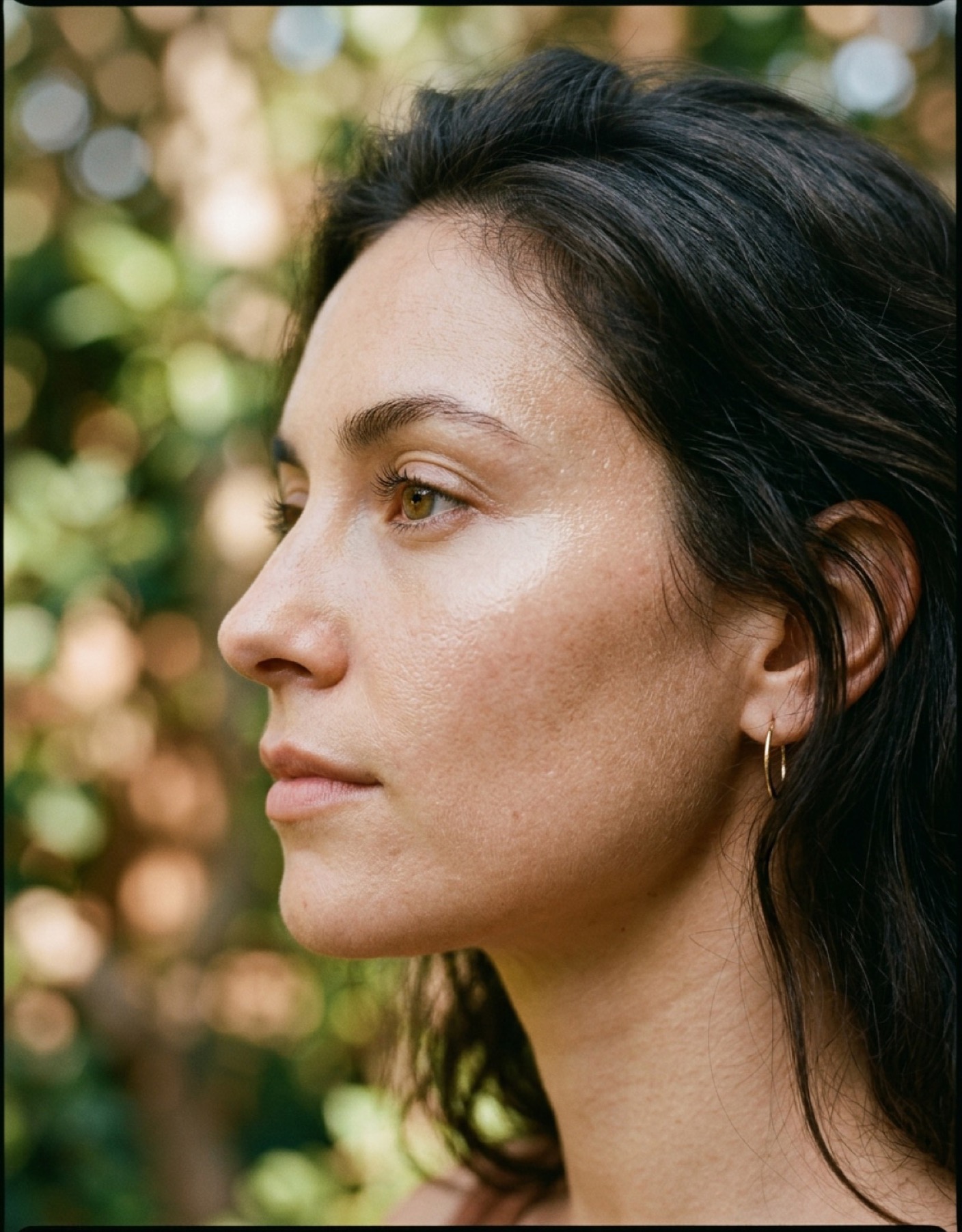 Malassezin Matches Hydroquinone for Melasma in Split-Face Trial